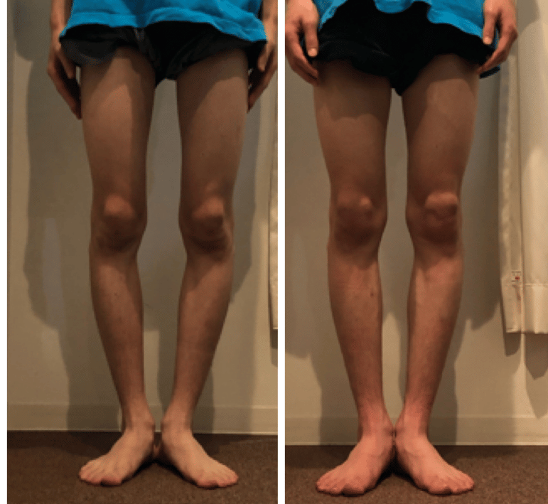 初回矯正後7.2㎝→4.2㎝